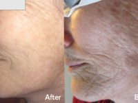 How Laser skin rejuvenation works?