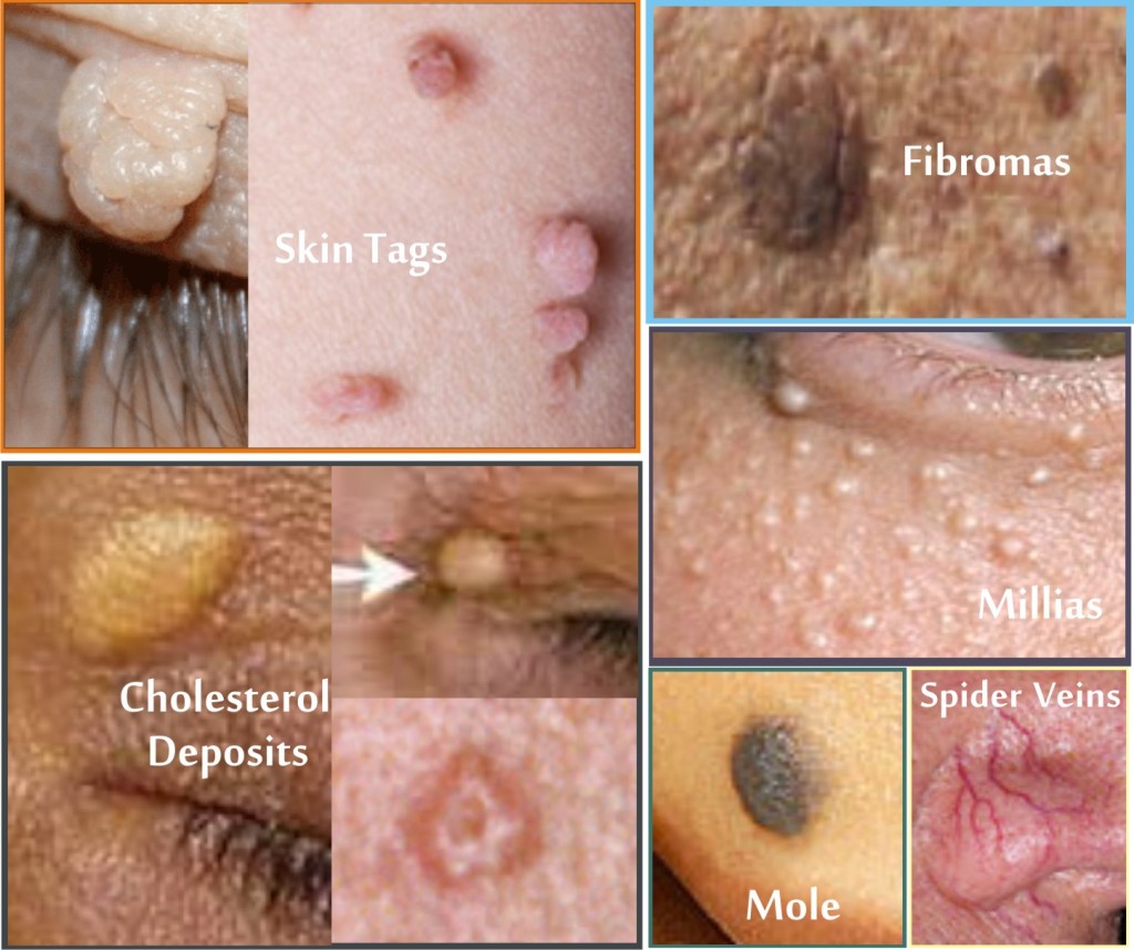 Age Spots on face, Skin Tag Removal, warts | Nell Laser Clinic