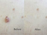 What Causes Skin Tags?