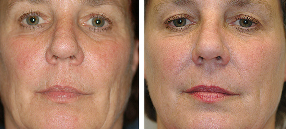 HIFU facelift, double chin treatments Skin tightening and rejuvenation.
