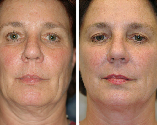 HIFU facelift, double chin treatments Skin tightening and rejuvenation.