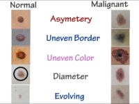 5 Signs of Malignant Moles: