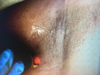 Laser Hair Removal and Common Questions (part 1)