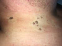 What Are the Causes of Skin Tags around the Neck? part 1