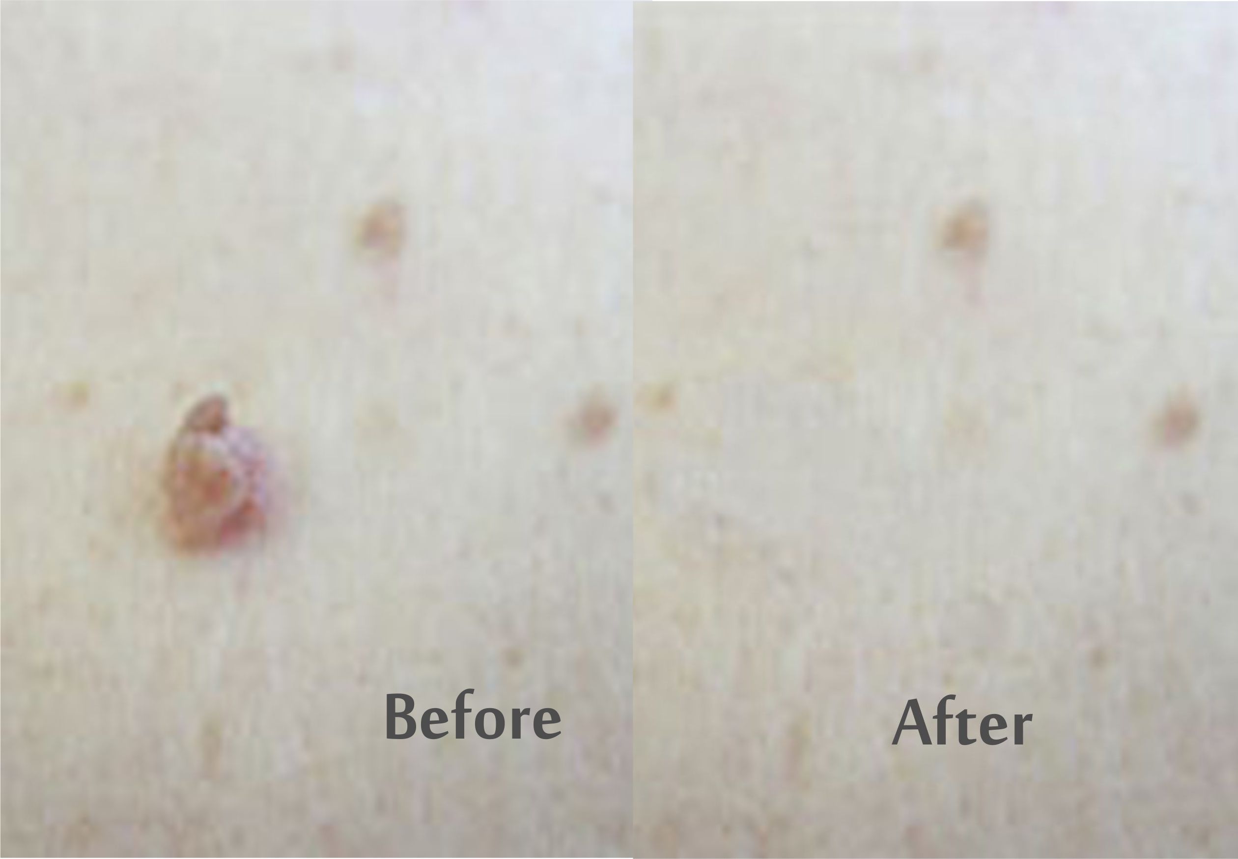anal skin tag causes anal skin tag causes