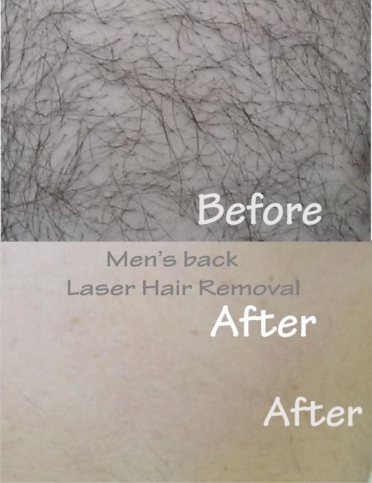 Laser Hair Removal Toronto, Facial hair removal Toronto ...
