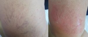 Spider veins removal, skin tags, age spots, HIUF facelift, laser hair removal
