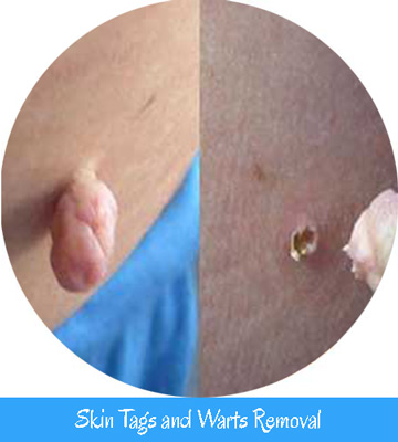 Skin Tags & Warts Removal Nell Laser