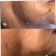 Skin tags, moles
