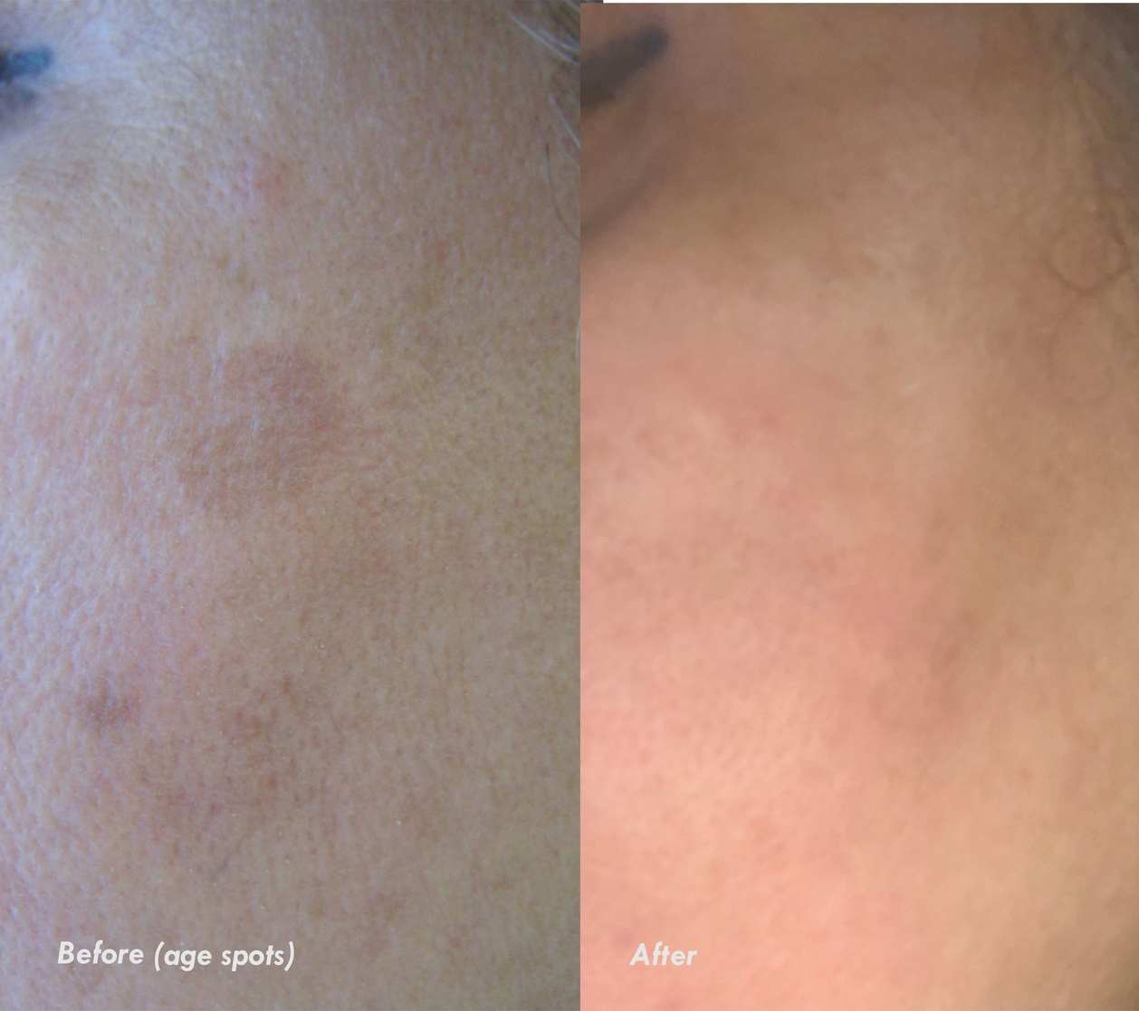Effective Age Spots and Sun Spots Treatment in North York Nell Laser