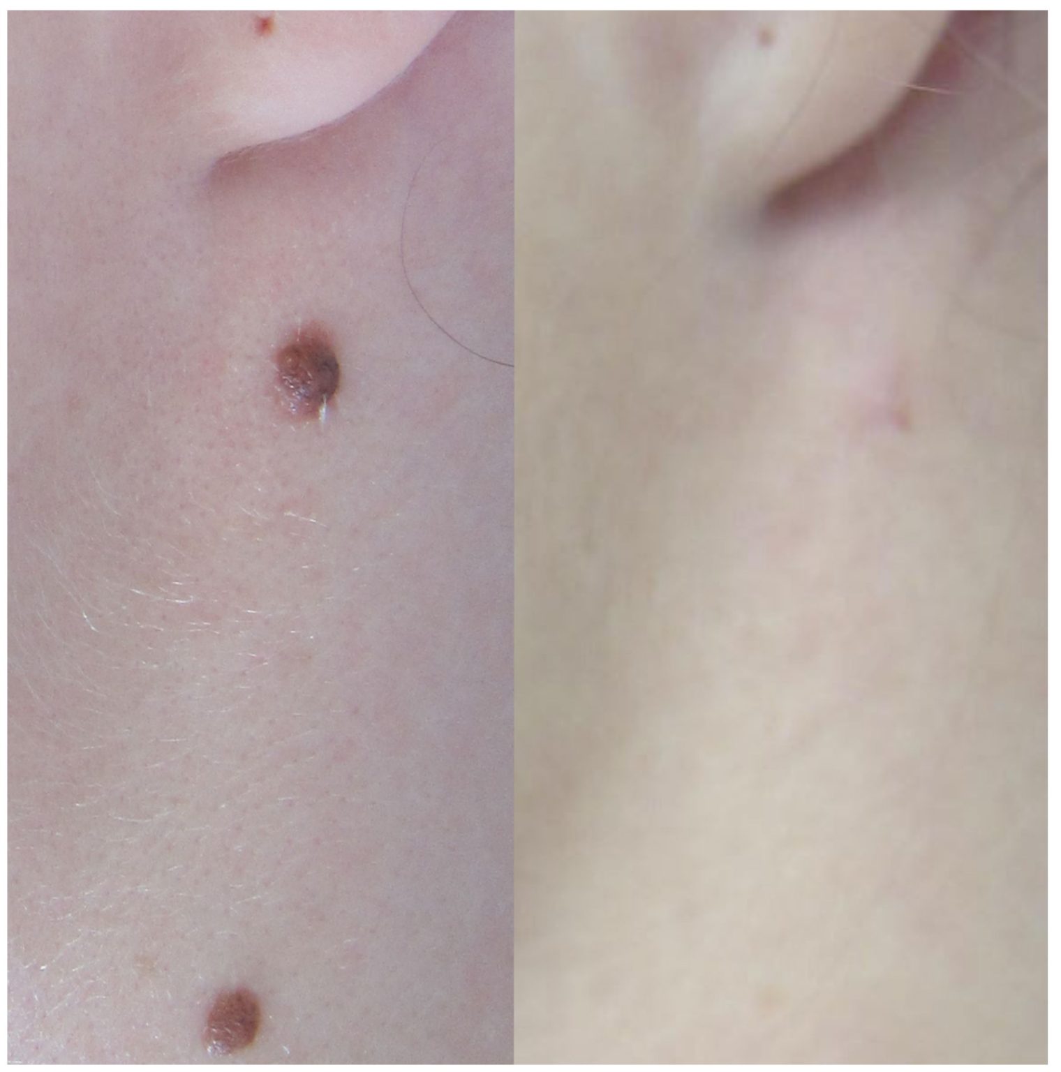 What Are The Causes Of Skin Tags Around The Neck Part 1 Nell Laser Clinic Laser Hair 