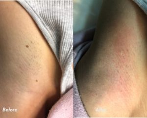 Skin tags removal, age spots removal Nell Laser Clinic
