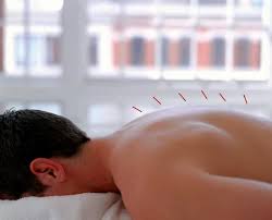 Relaxing acupuncture session in a modern clinic setting. Experience relief and wellness with our registered acupuncturist. Book your appointment today for holistic healing.