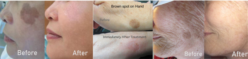 age spots and sun spots treatment in north york. Nell laser Clinic