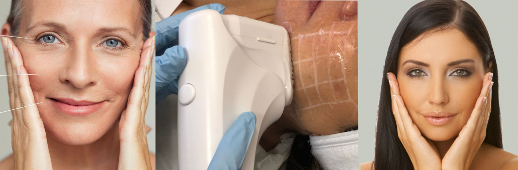 Facelift 3D HIFU, Double Chin, Nell Laser Clinic,,