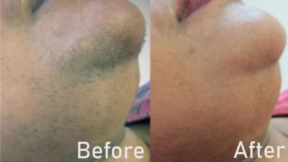 Laser hair removal at Nell Laser & Cosmetic Clinic in Toronto using advanced laser technology.