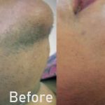 Laser hair removal at Nell Laser & Cosmetic Clinic in Toronto using advanced laser technology.