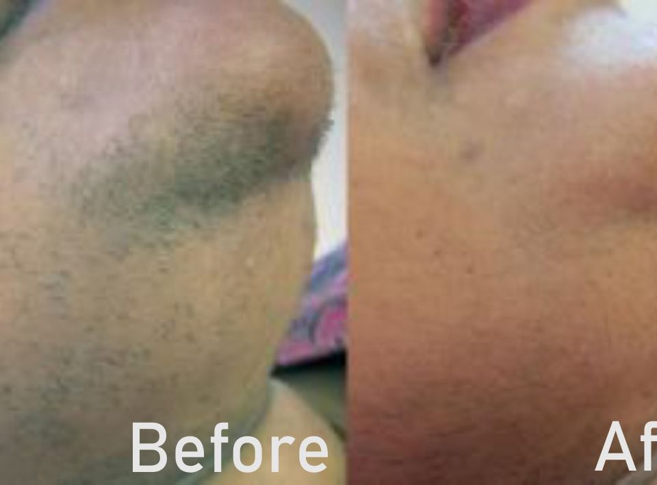 Laser hair removal at Nell Laser & Cosmetic Clinic in Toronto using advanced laser technology.