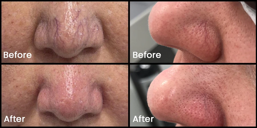 Laser Spider Vein Treatment Cost