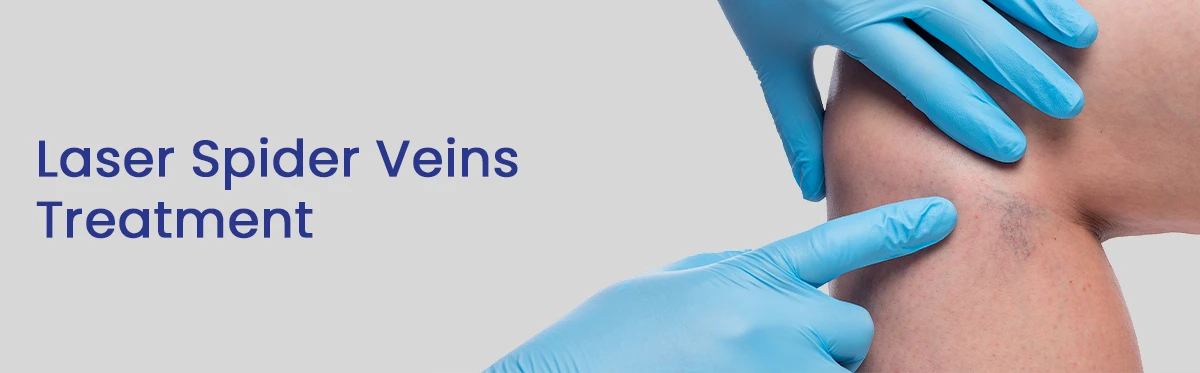 Laser Spider Veins Treatment