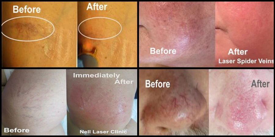 Laser spider veins treatment in Toronto