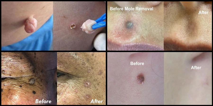Skin Tags Removal in North York