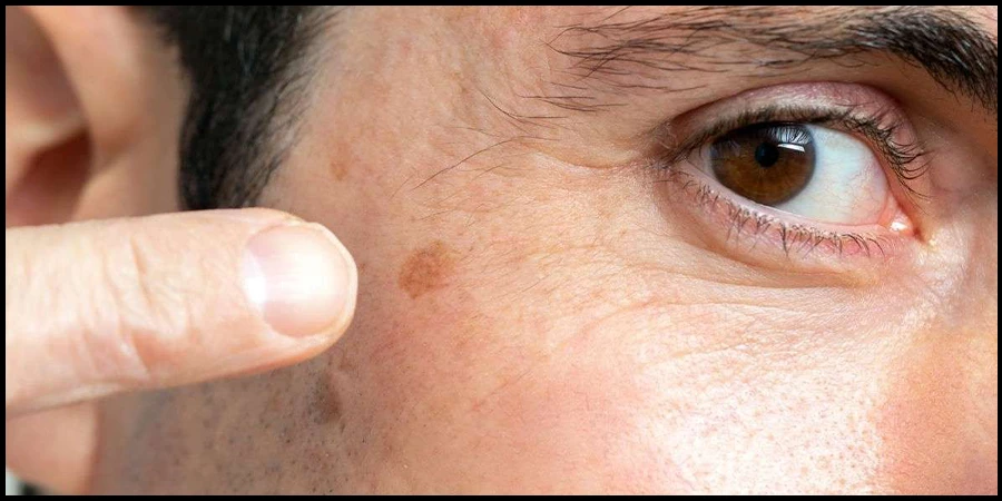 Best Treatment for Age Spots on the Face