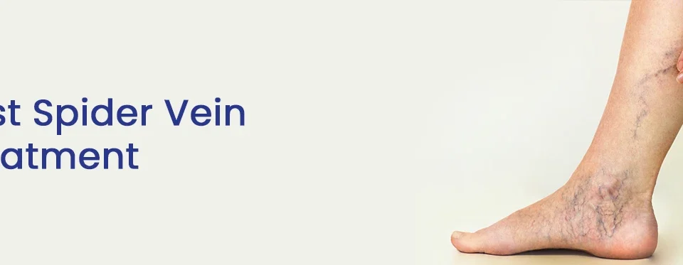 Best Spider Vein Treatment