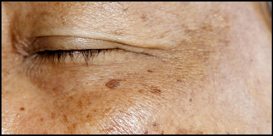 Best Treatment for Age Spots on the Face