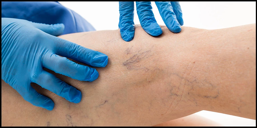 How to Get Rid of Spider Veins in a natural way