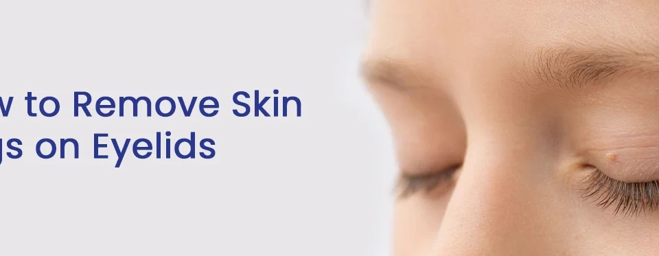 Remove Skin Tags on Eyelids