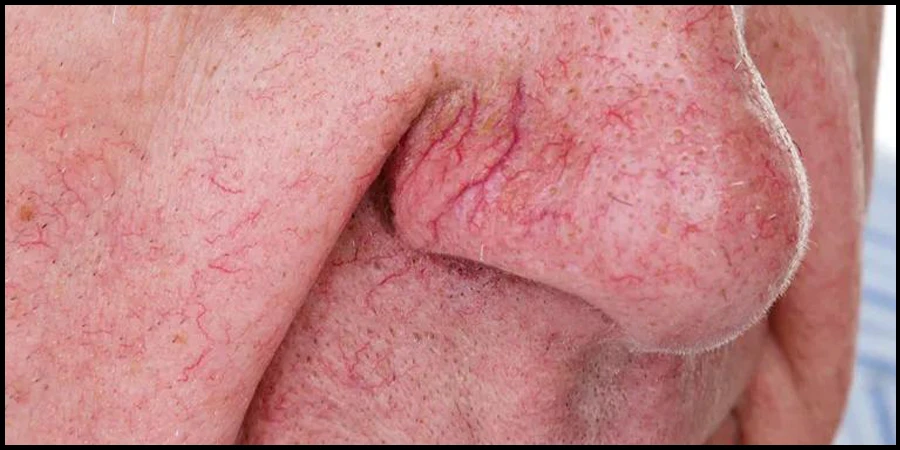 Spider Vein Removal