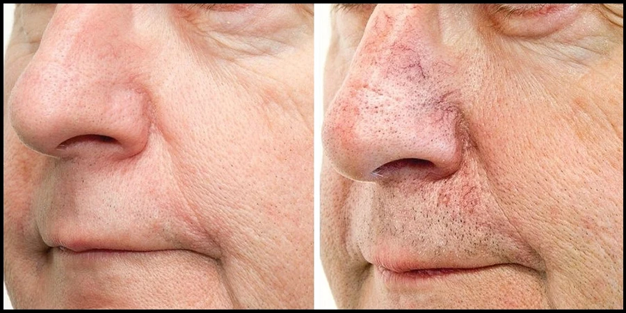 Spider Vein on the Nose Treatments Aftercare