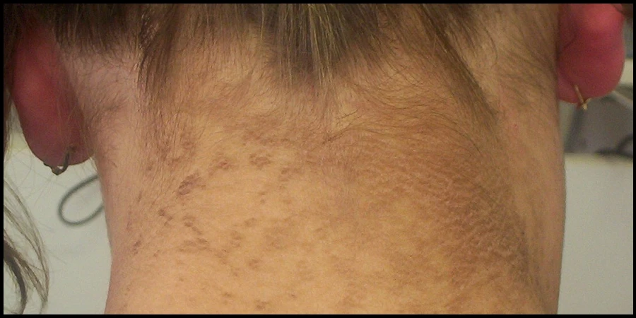 Sun Spots on Neck Removal at Nell Clinic