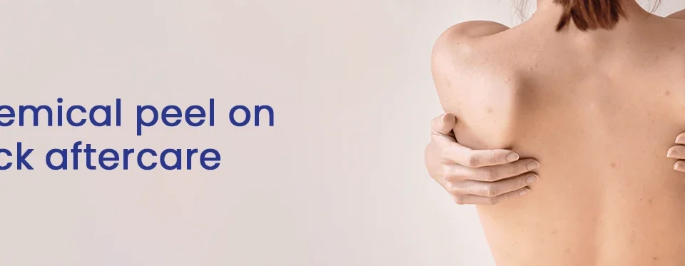 Chemical peel on back aftercare