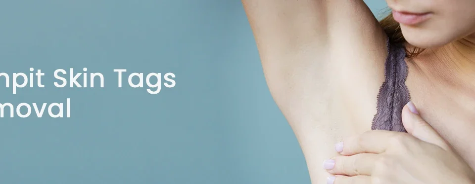 Armpit Skin Tags Removal