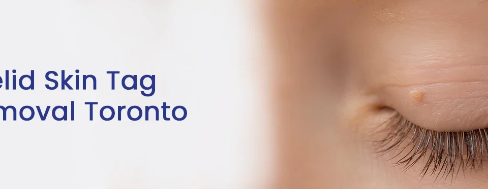 Eyelid Skin Tag Removal Toronto