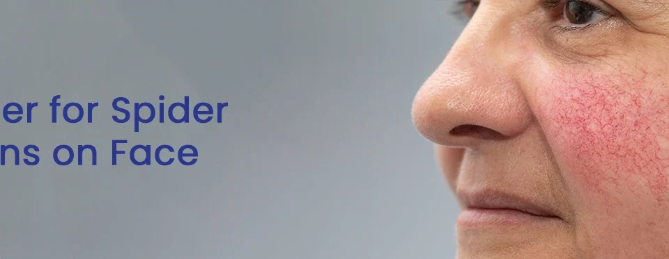 Laser for Spider Veins on Face