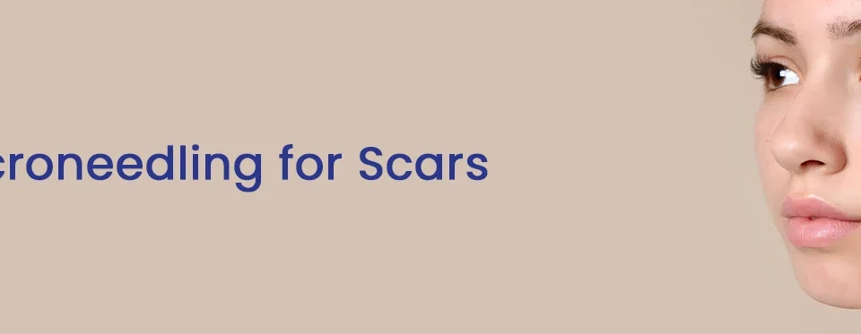 Microneedling for Scars