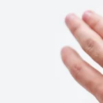 Wart Removal Toronto