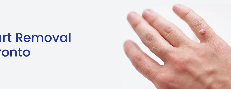 Wart Removal Toronto