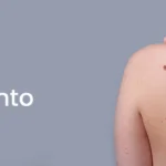 Best Skin Tag Removal Toronto