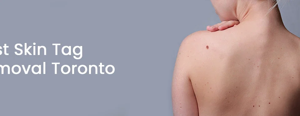 Best Skin Tag Removal Toronto
