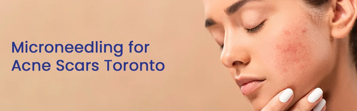 Microneedling for Acne Scars Toronto