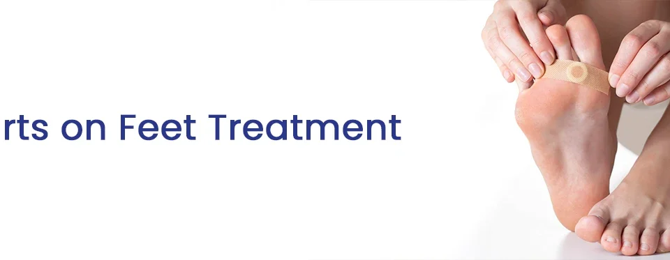 Warts on Feet Treatment