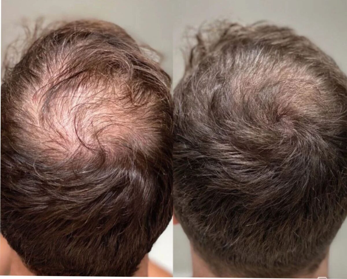 PRP hair restoration treatment at Nell Laser & Cosmetic Clinic in Toronto.
