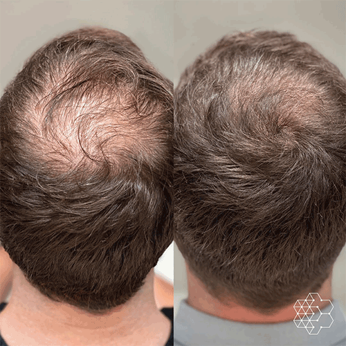PRP hair restoration treatment at Nell Laser & Cosmetic Clinic in Toronto.