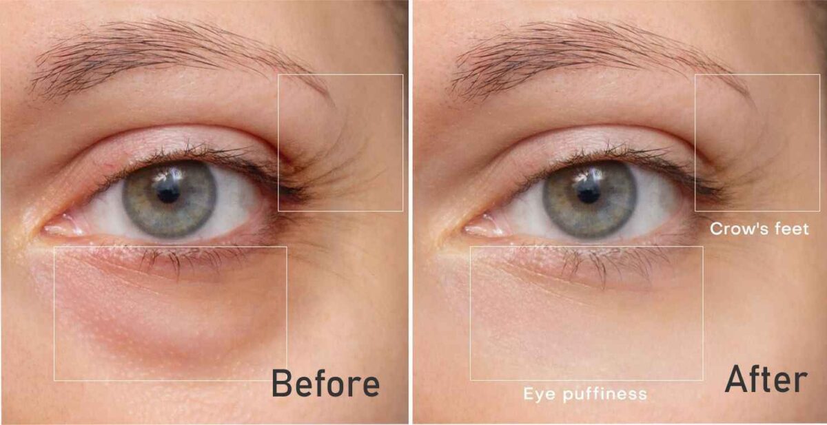 RF Skin & Eye Rejuvenation at Nell Laser & Cosmetic Clinic