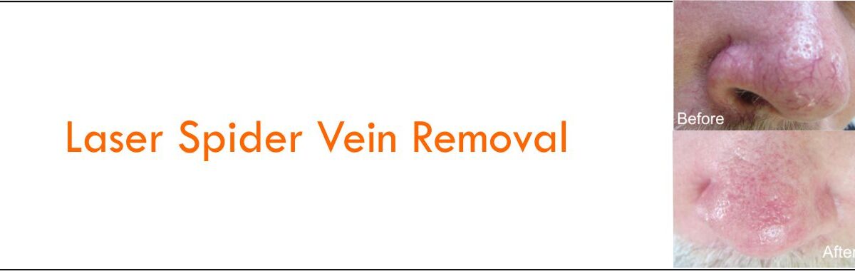 FDA-Approved Laser For Spider Vein Removal