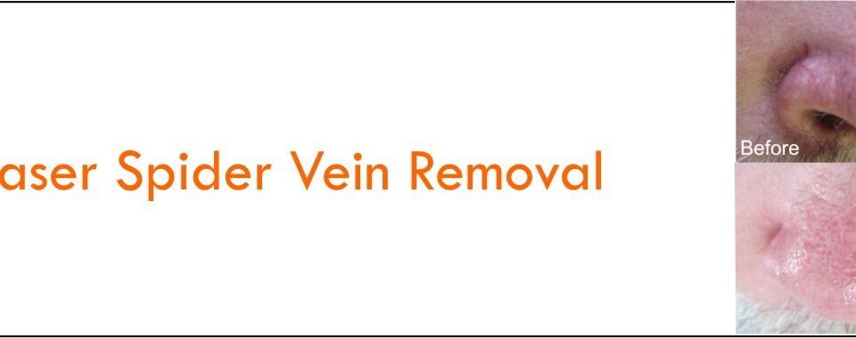 FDA-Approved Laser For Spider Vein Removal